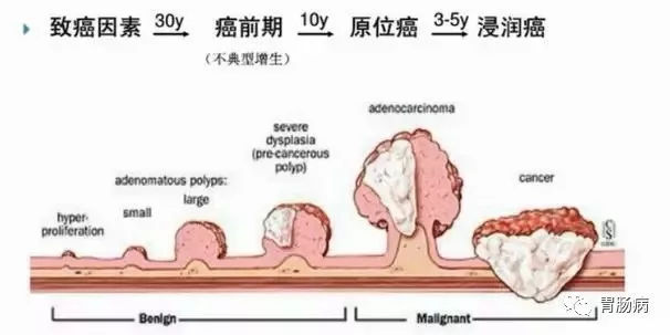 體檢查出腸息肉一定要切除！ 95%腸癌由它演變而來