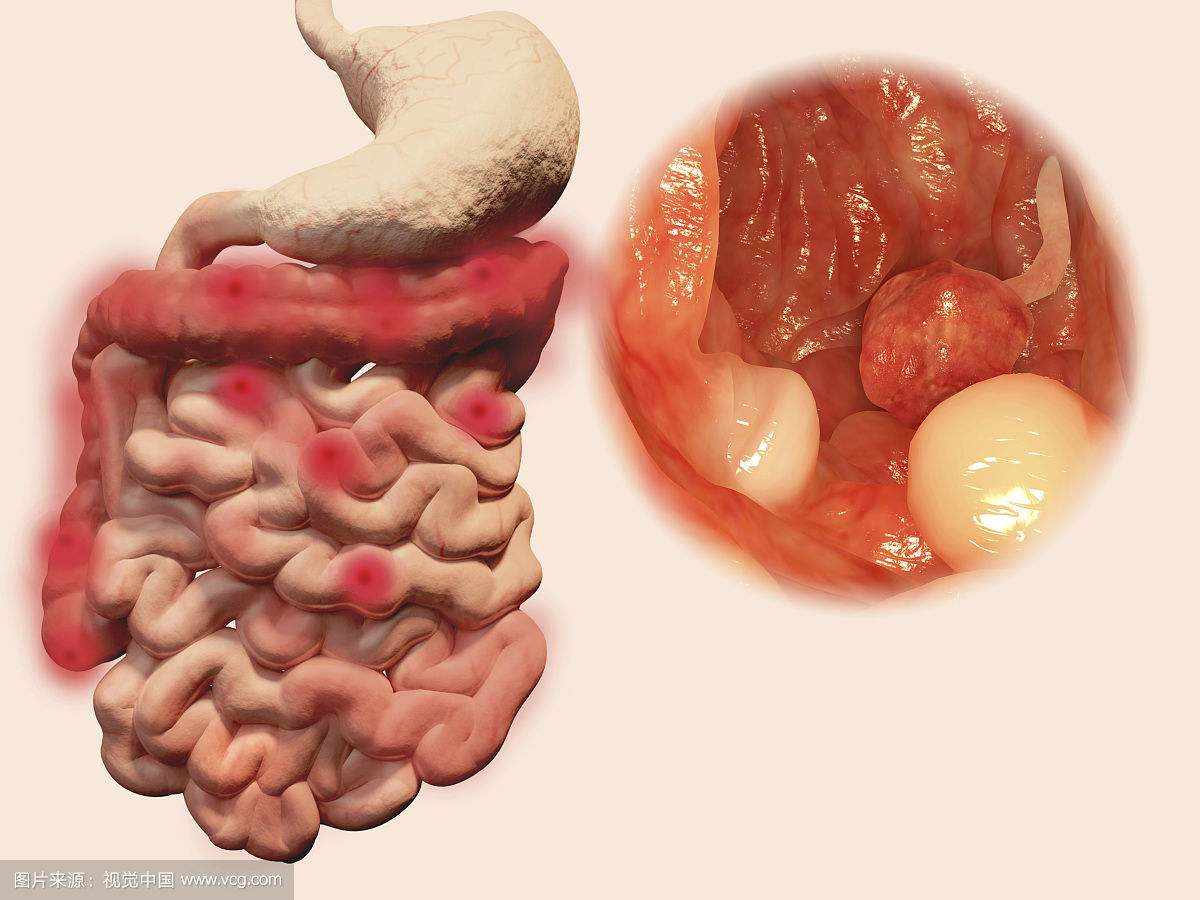 南寧慢性腸炎的費(fèi)用是多少錢(qián)