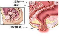 南寧治療脫肛哪家醫(yī)院好？南寧脫肛治療多少錢？